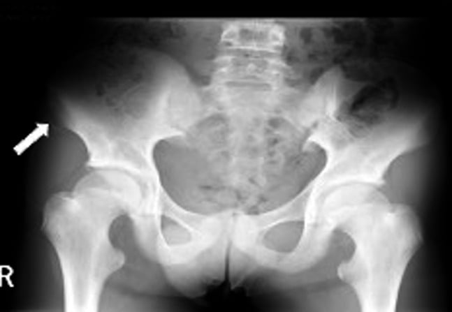 AP pelvis radiograph with an arrow marking a slightly displaced right ASIS avulsion fragment