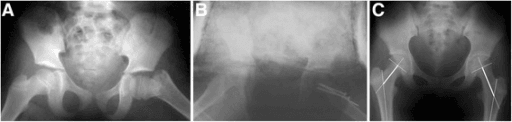 Paediatric Delbet type II (transcervical) femoral neck fracture: AP and lateral radiographs and post-fixation views.