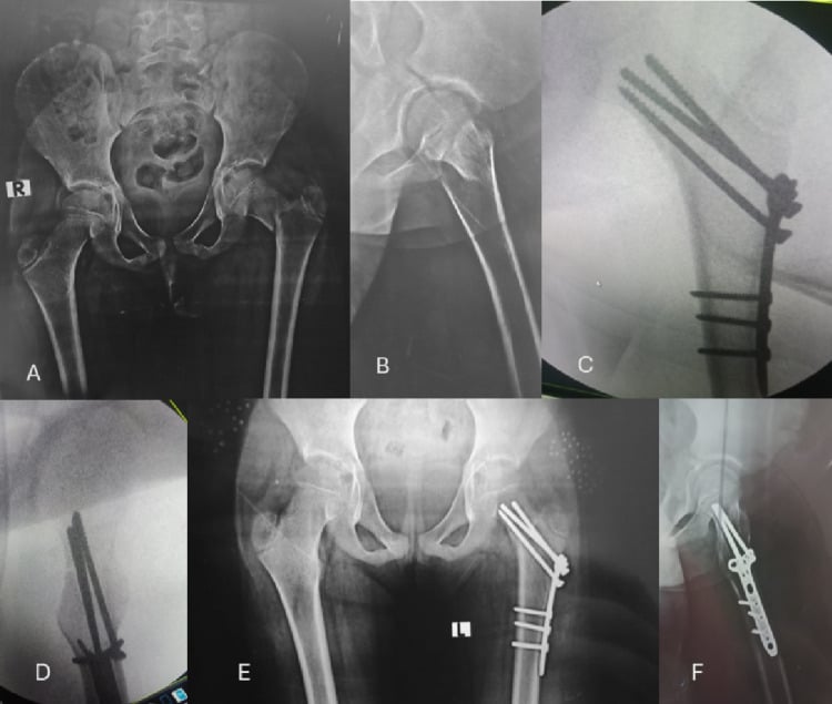 Radiographs and fluoroscopic views of Delbet III femoral-neck fracture reduction and T-plate fixation
