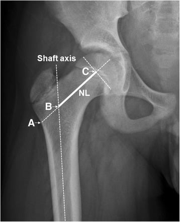 Radiographic diagram showing femoral-neck length and neck-shaft angle measurements