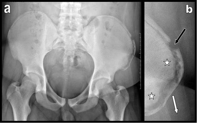 AP pelvis and focused radiographs of an anterior iliac-crest apophyseal avulsion