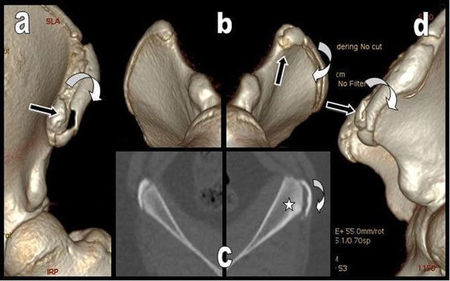 Axial and three-dimensional CT views of an iliac-crest apophyseal avulsion