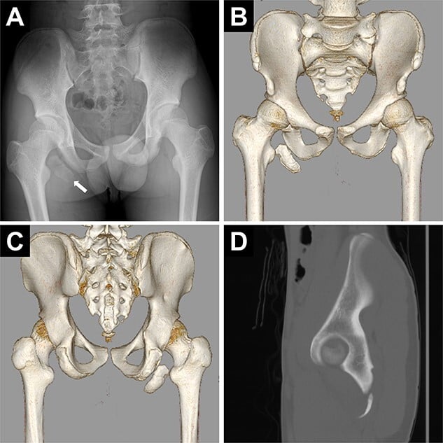 Pelvic radiograph and CT reconstructions of a displaced ischial-tuberosity avulsion