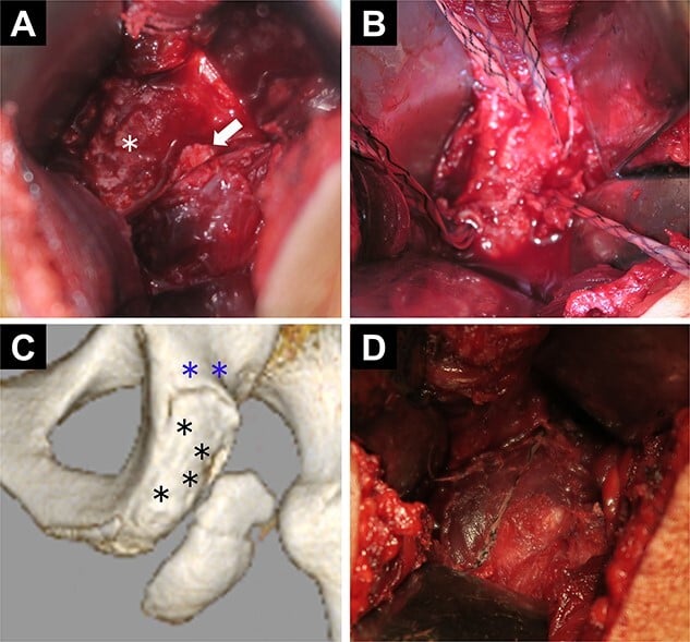 Operative views and CT model of ischial-tuberosity avulsion repair