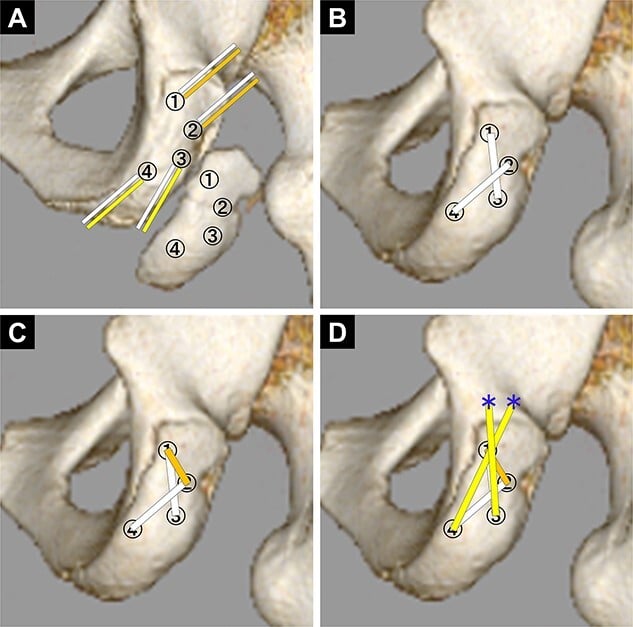Four-step diagram of suture-anchor bridge fixation for an ischial-tuberosity avulsion