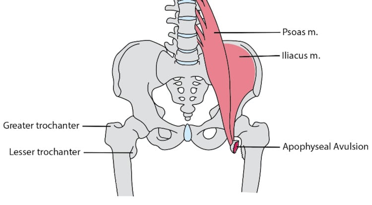Diagram of the iliopsoas insertion and lesser-trochanter apophyseal avulsion