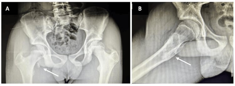 AP and lateral radiographs of a displaced lesser-trochanter apophyseal avulsion