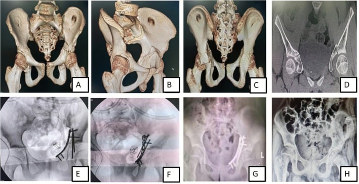 Three-dimensional CT, fluoroscopic and follow-up views of paediatric acetabular fracture fixation