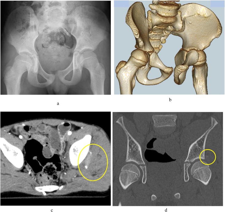 Pelvic radiograph and CT showing ring disruption and small posterior acetabular fragments before later hip subluxation