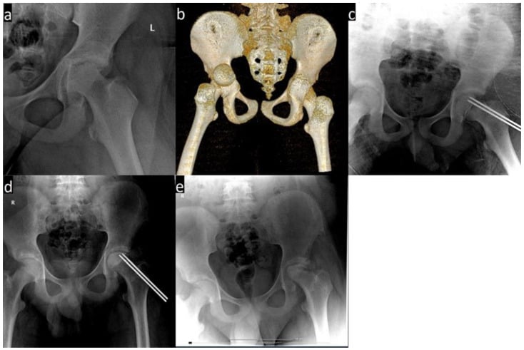 Radiograph, CT and follow-up sequence of transphyseal hip fracture-dislocation progressing to avascular necrosis