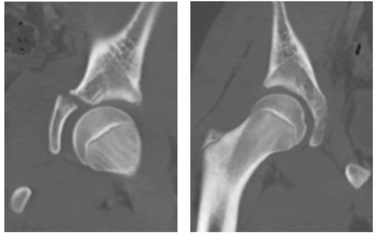 Two coronal CT slices through the hip showing a displaced triradiate cartilage acetabular fracture with a separated acetabular fragment
