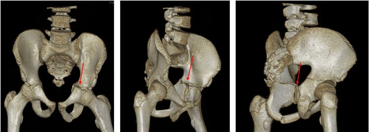 Three-dimensional CT reconstruction of a triradiate cartilage acetabular fracture