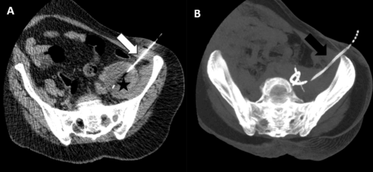 Axial CT images showing needle and catheter insertion into a left psoas abscess under CT guidance