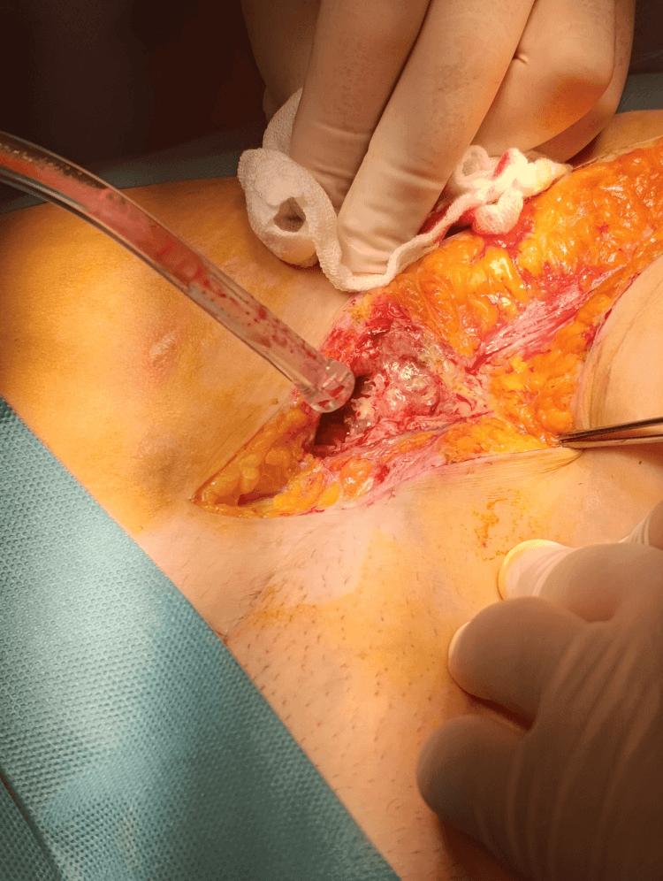 Imaging showing a retroperitoneal fusiform collection tracking along the inguino-crural path toward Scarpa’s triangle