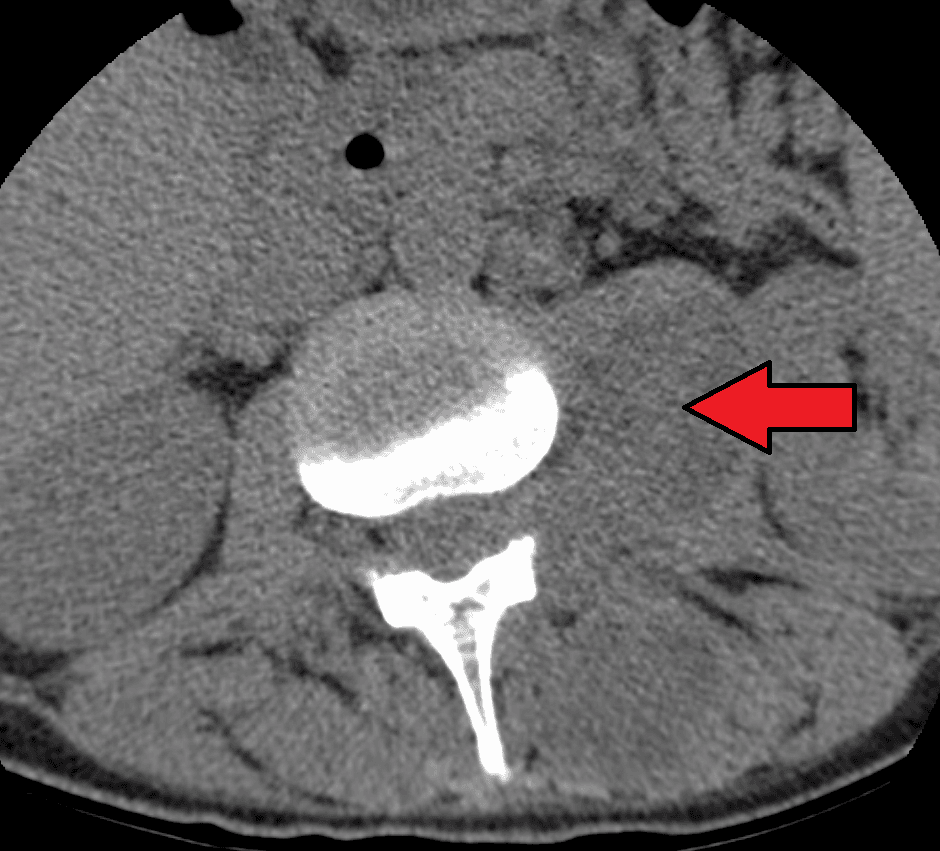 Axial CT of the lumbar region showing an enlarged, abnormal psoas muscle on one side, indicated by an arrow, in a psoas (paraspinal) abscess