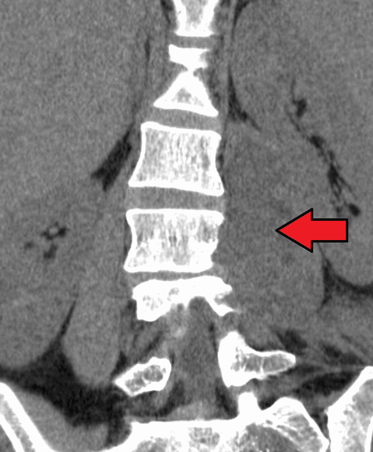 Coronal reformatted CT of the lumbar spine showing a psoas abscess tracking alongside the vertebral bodies, indicated by an arrow