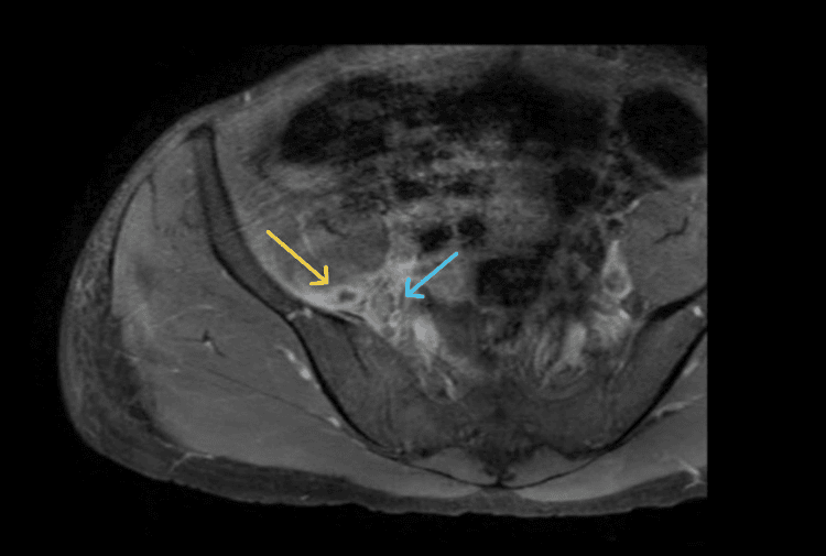 Axial T1 MRI of the pelvis showing a small psoas abscess collection with an enhancing deep soft-tissue area