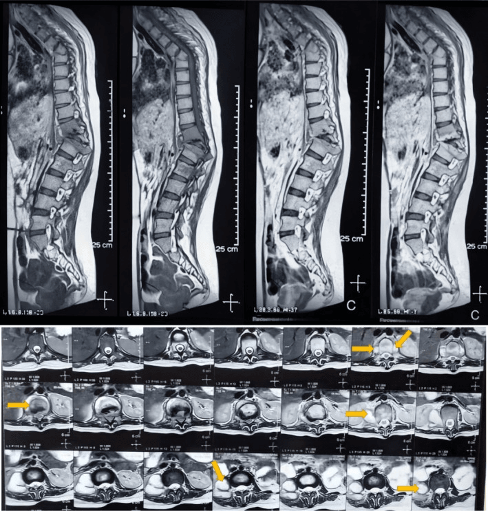 Spinal MRI showing vertebral body destruction with adjacent soft-tissue involvement in paediatric tuberculous spondylitis