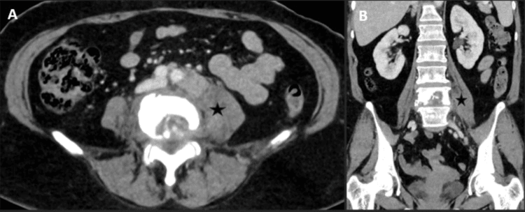 Follow-up axial and coronal CT showing marked interval reduction of a left psoas abscess after drainage
