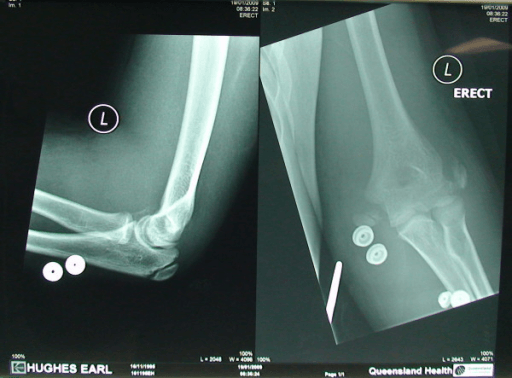 Paediatric biepicondylar elbow fracture-dislocation