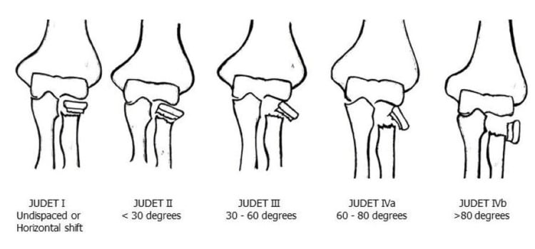 Judet classification diagram for paediatric radial-neck fractures, labelled type I undisplaced or horizontal shift, type II under 30 degrees, type III 30-60 degrees, type IVa 60-80 degrees and type IVb over 80 degrees