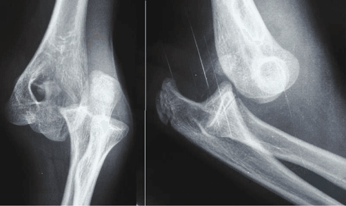 Paediatric elbow medial epicondyle anatomy and dislocation entrapment