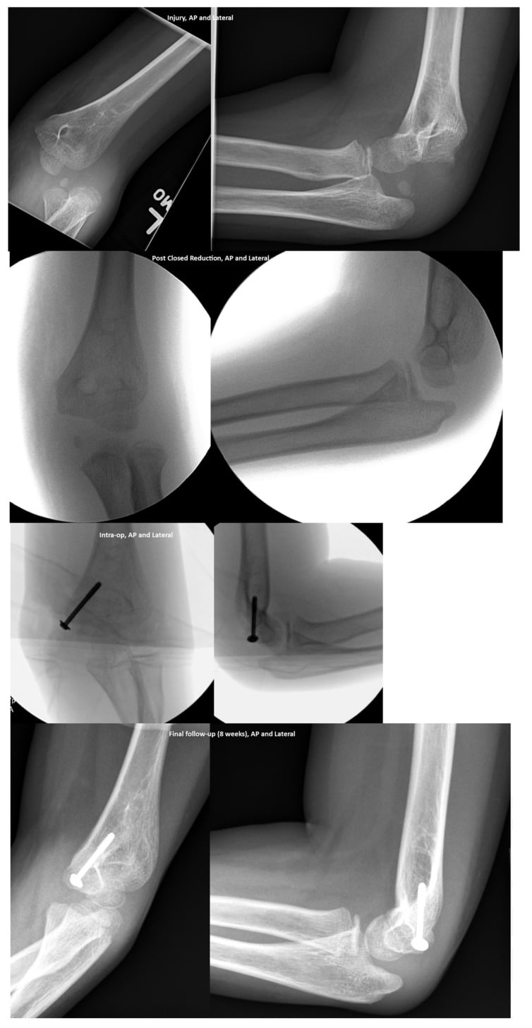 Serial AP and lateral radiographs and fluoroscopy of an elbow dislocation with medial-epicondyle avulsion: injury, post closed reduction, intra-operative screw fixation and eight-week follow-up