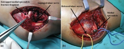 Operative views: (a) entrapped medial epicondyle fracture fragment and impinged ulnar nerve; (b) released ulnar nerve and medial epicondyle fixed with a screw