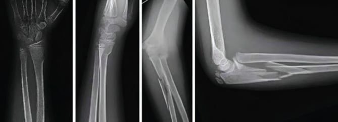 Wrist, forearm and elbow radiographs of a paediatric Monteggia-equivalent injury with proximal ulna, radial-neck and distal-radius fractures