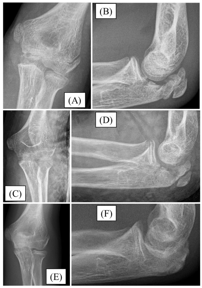 Serial AP and lateral radiographs, panels A to F, showing reduction and healing of a paediatric olecranon fracture