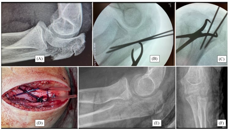 Radiographic, fluoroscopic and operative sequence, panels A to F, of paediatric olecranon fixation with resorbable pins