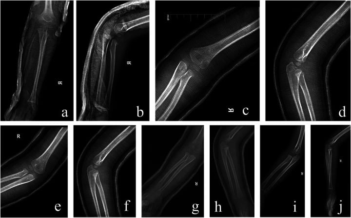 Intraoperative fluoroscopy of Métaizeau retrograde intramedullary pinning for radial neck fracture