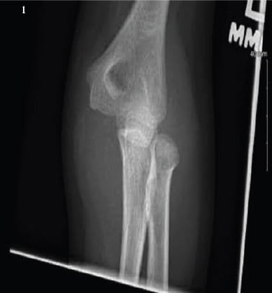 Radiographs of pediatric elbow dislocation with entrapped medial epicondyle fragment
