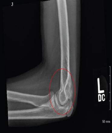 Postoperative radiographs showing open reduction and screw fixation of entrapped medial epicondyle fragment