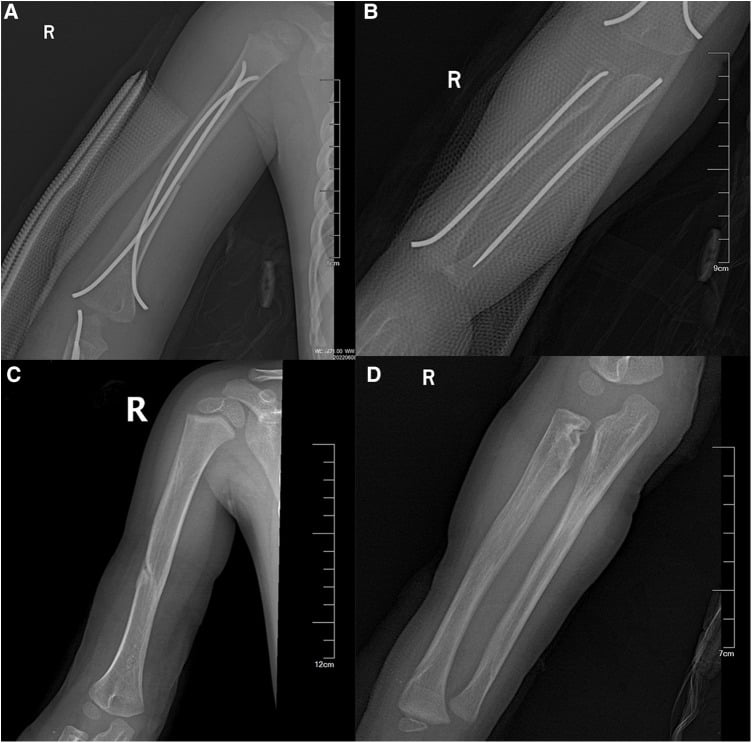 Serial paediatric forearm radiographs, panels A to D, showing radial-head avascular necrosis after intramedullary nail fixation