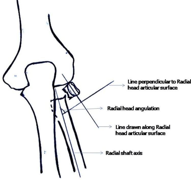 Diagram of paediatric radial-head angulation measured between the radial shaft axis and a line perpendicular to the radial-head articular surface