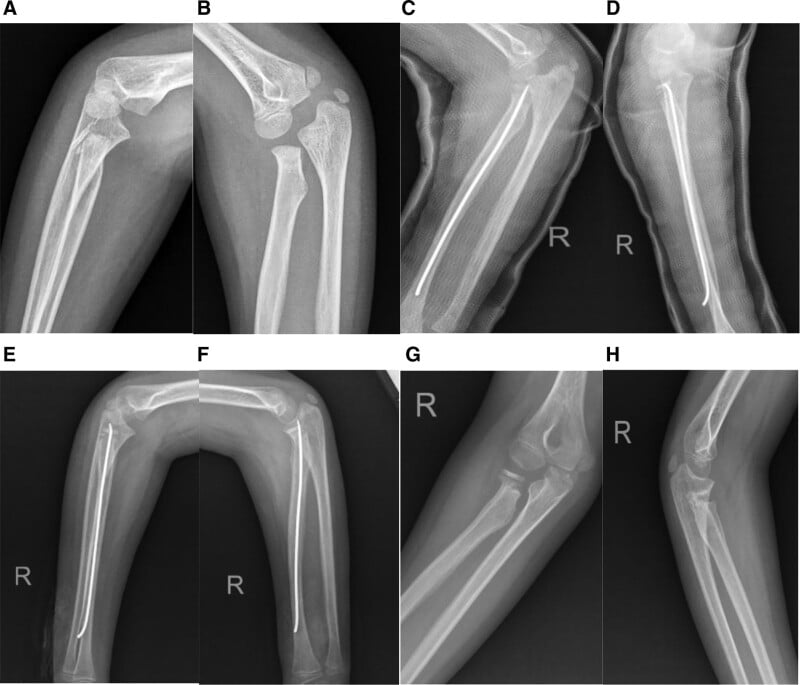 Serial elbow and forearm radiographs, panels A to H, showing elastic intramedullary nail migration into the joint after radial-neck fixation