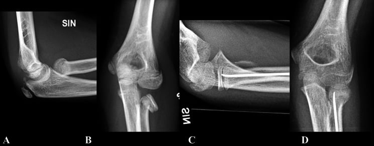 Pre-operative (A, B) and follow-up (C, D) radiographs of a Judet IV radial-neck fracture treated with the Metaizeau technique