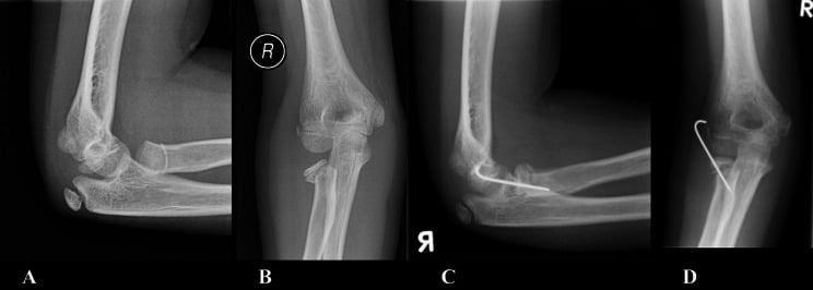 Pre-operative (A, B) and follow-up (C, D) radiographs of a Judet III radial-neck fracture treated with a percutaneous K-wire