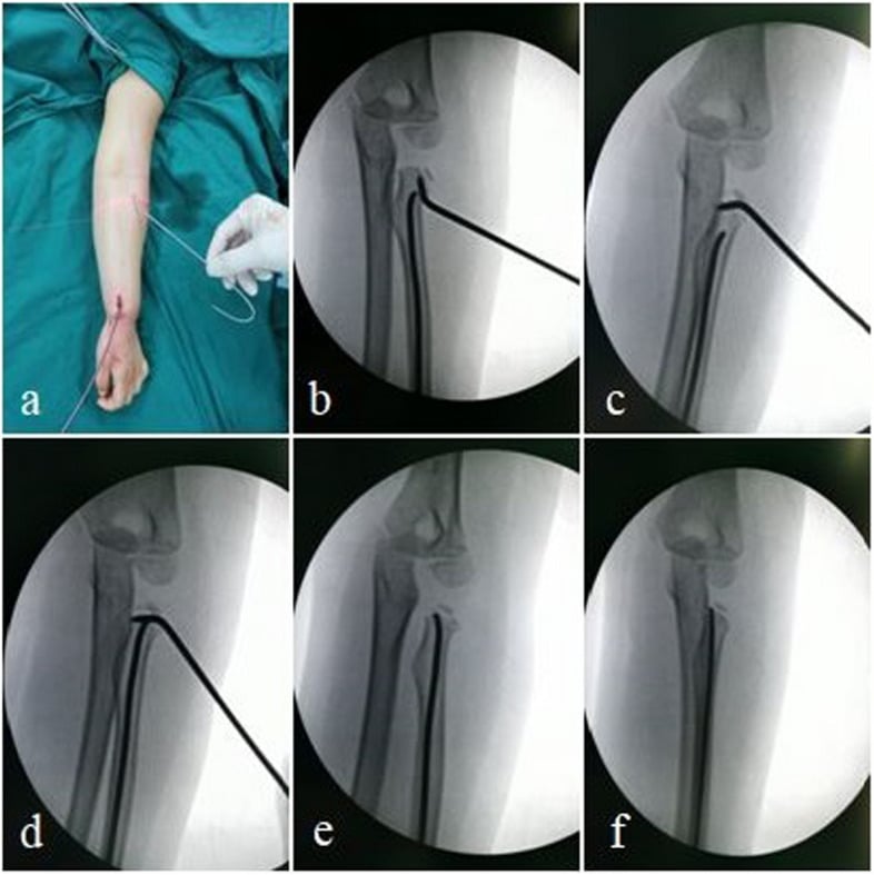 Operative photograph and fluoroscopic sequence, panels a to f, of percutaneous radial-neck reduction with intramedullary stabilisation