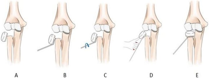 Five-step diagram, panels A to E, of percutaneous K-wire rotation-prying reduction of a radial-neck fracture