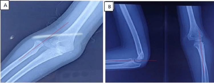Paediatric elbow radiographs with the radiocapitellar line drawn in red: panel A before reduction, panel B lateral and AP views after closed reduction