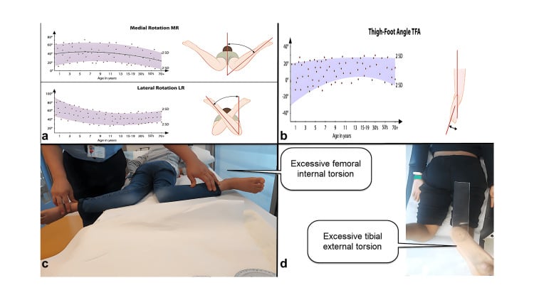 Paediatric rotational-profile examination composite showing age-referenced hip rotation and thigh-foot angle ranges with prone hip rotation and standing tibial torsion examples
