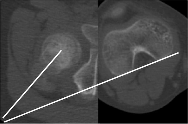 Paired axial CT images with femoral neck and posterior condylar axes used to calculate femoral anteversion