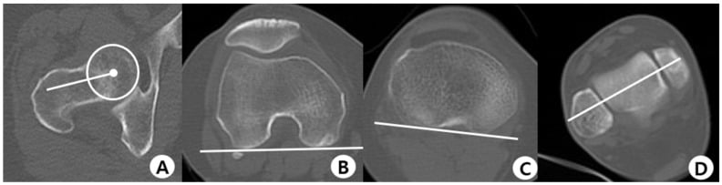 Four axial CT levels showing femoral neck, posterior femoral condyle, proximal tibial plateau and bimalleolar reference axes