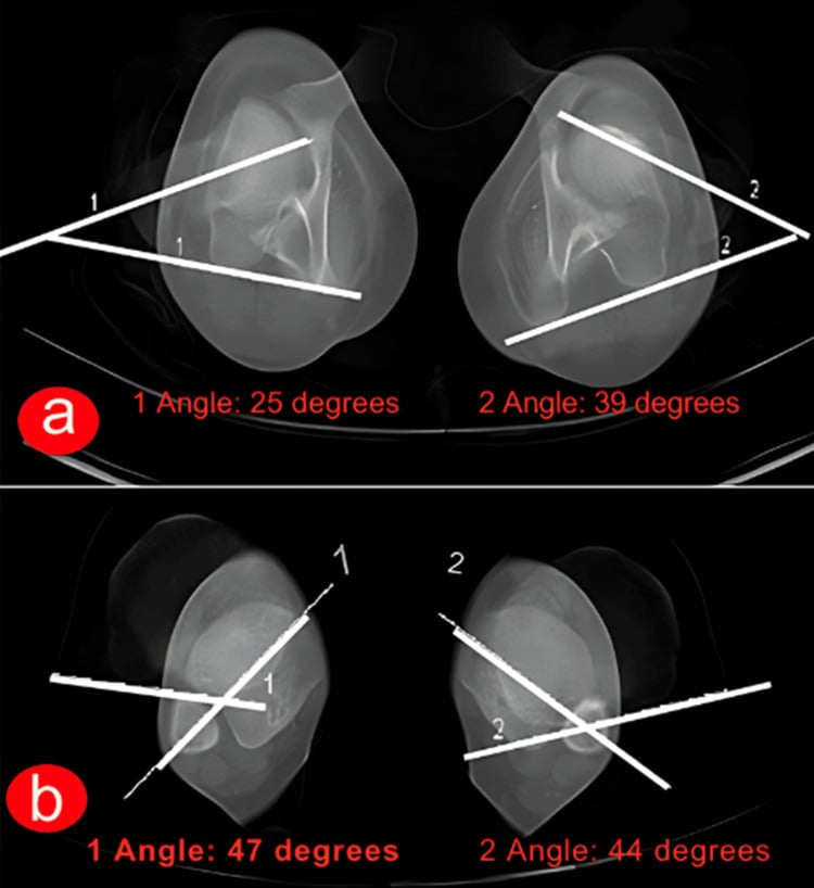 Bilateral axial CT rotation profile with measured femoral and tibial torsion angles on both sides