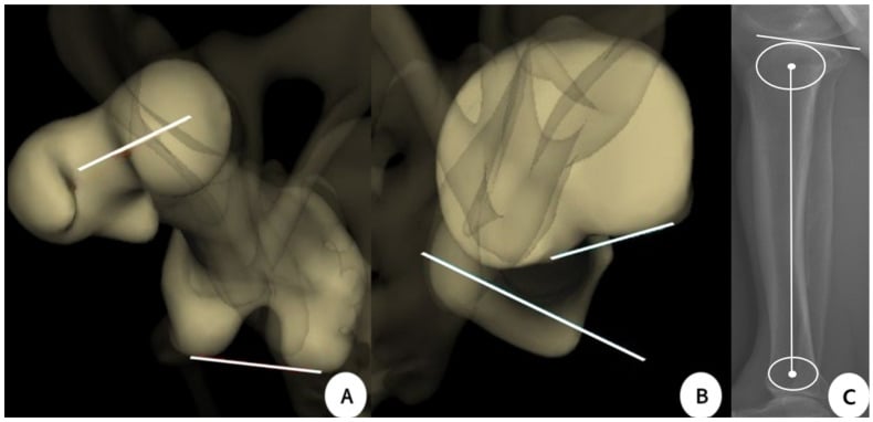 EOS three-dimensional reconstructions showing femoral and tibial torsion reference axes beside a standing lateral reconstruction