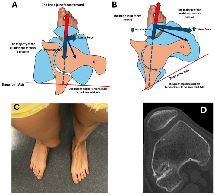 Diagram and clinical lower-limb view showing how excessive external tibial torsion turns the knee axis inward despite a near-forward foot progression angle