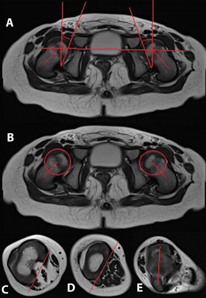 Axial MRI rotational profile showing reference lines for acetabular version, femoral torsion and tibial torsion at proximal and distal levels