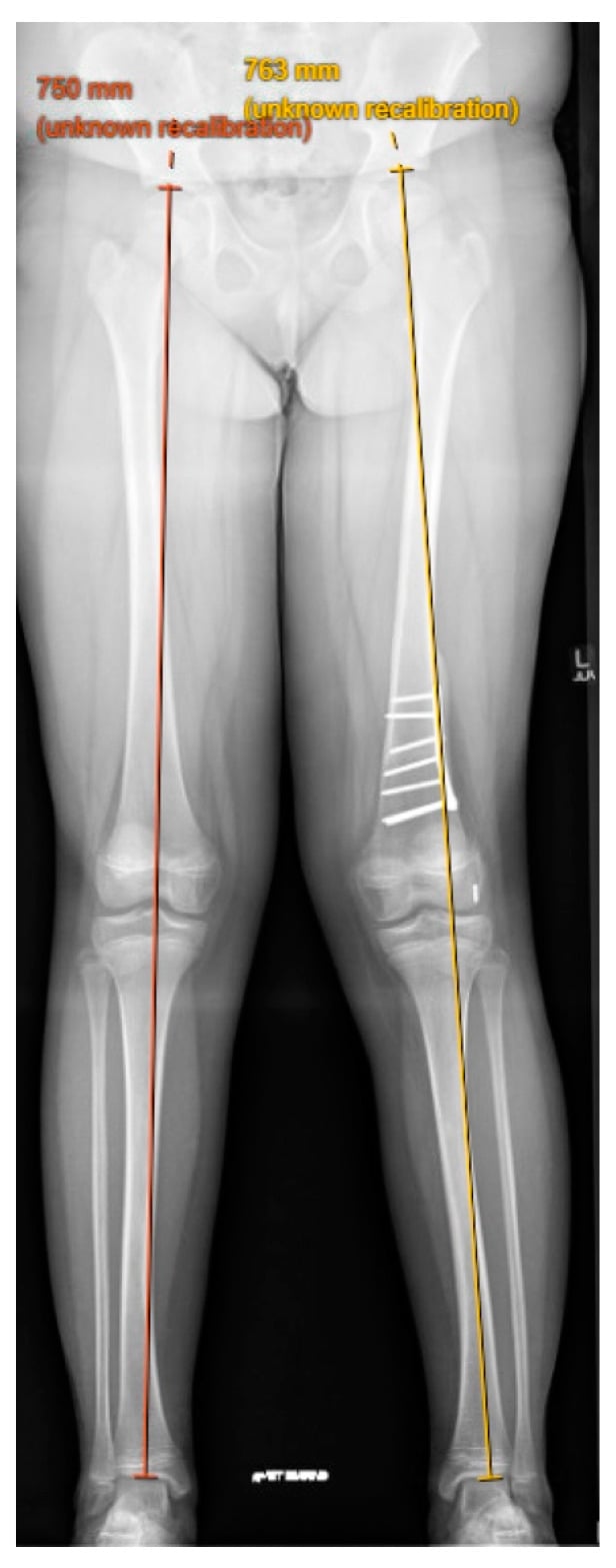 Standing long-leg radiograph of an eleven-year-old with persistent left genu valgum and patellar instability after femoral derotation osteotomy